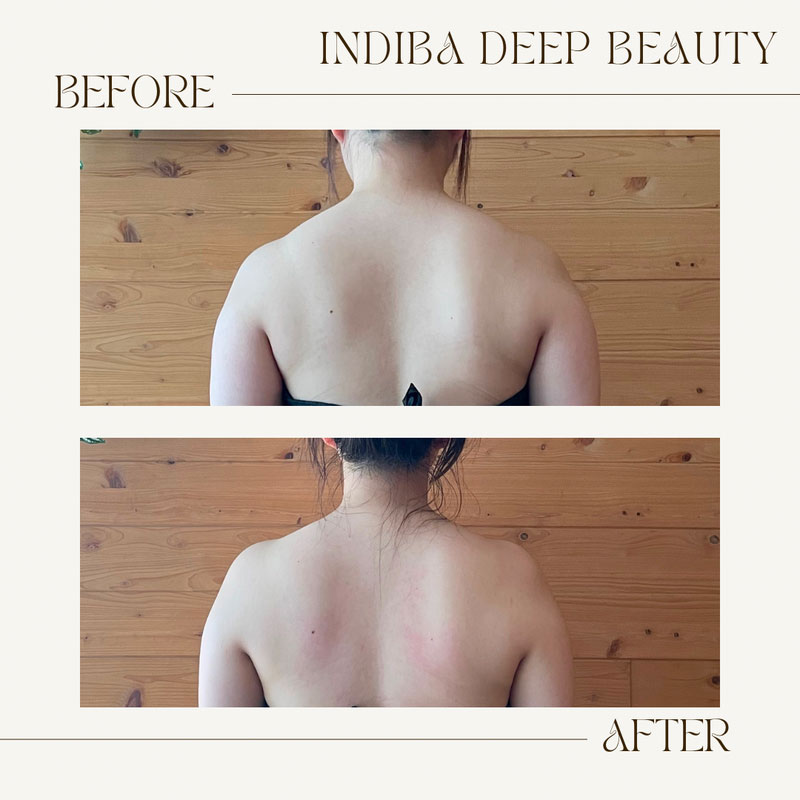 インディバ施術ビフォーアフター