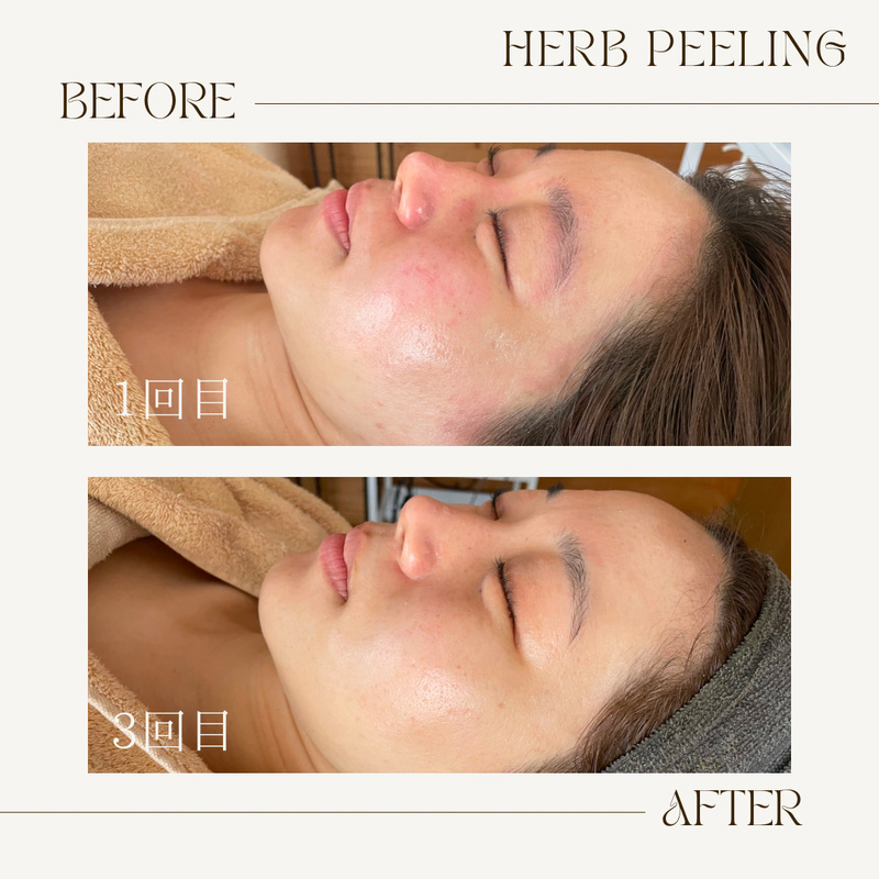 ハーブピーリングビフォーアフター