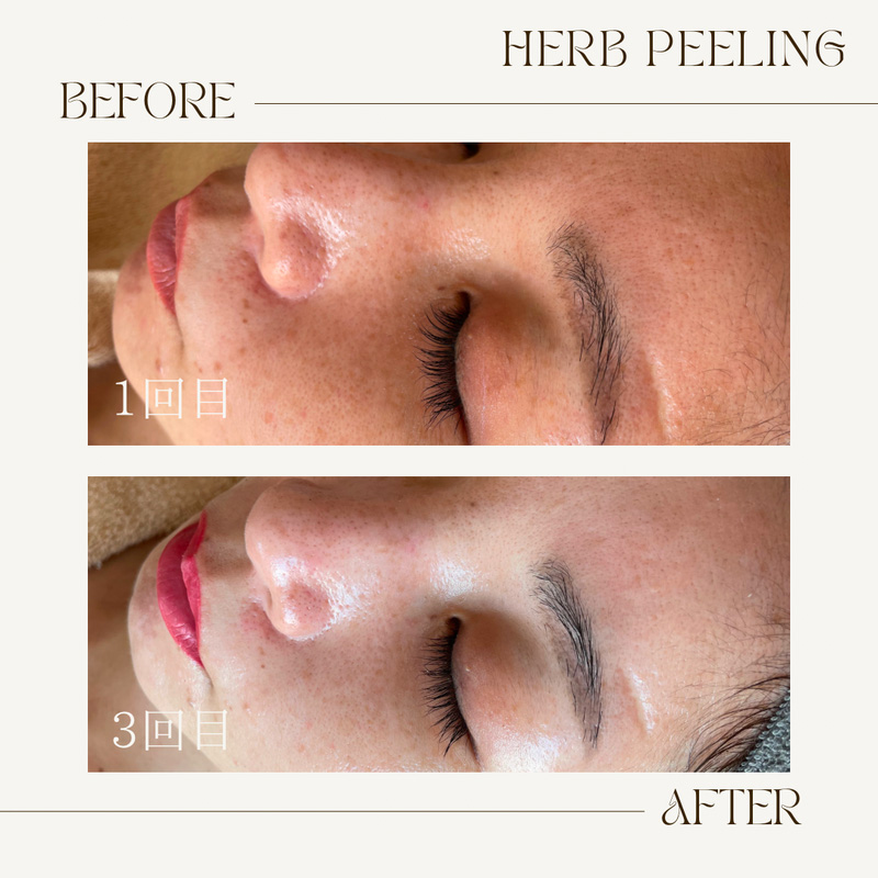 ハーブピーリング、ビフォーアフター