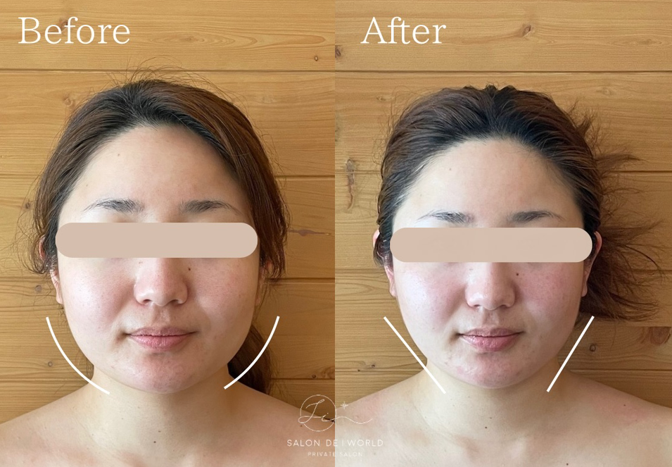 インディバビフォーアフター顔