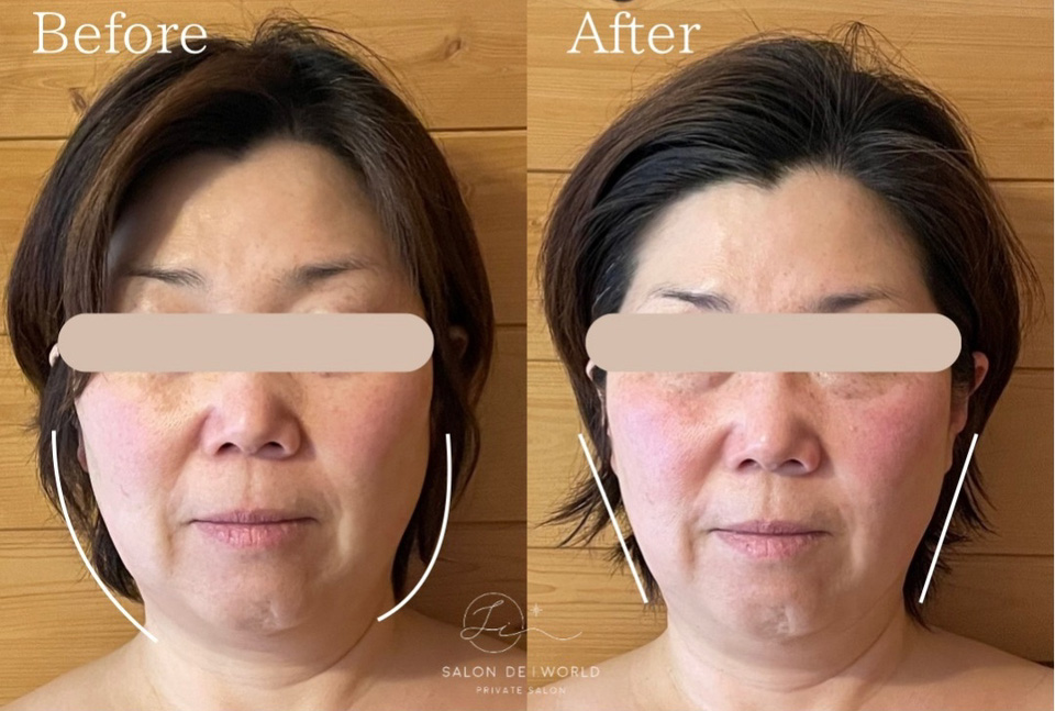 サロンドアイワールド・インディバ・ビフォーアフター