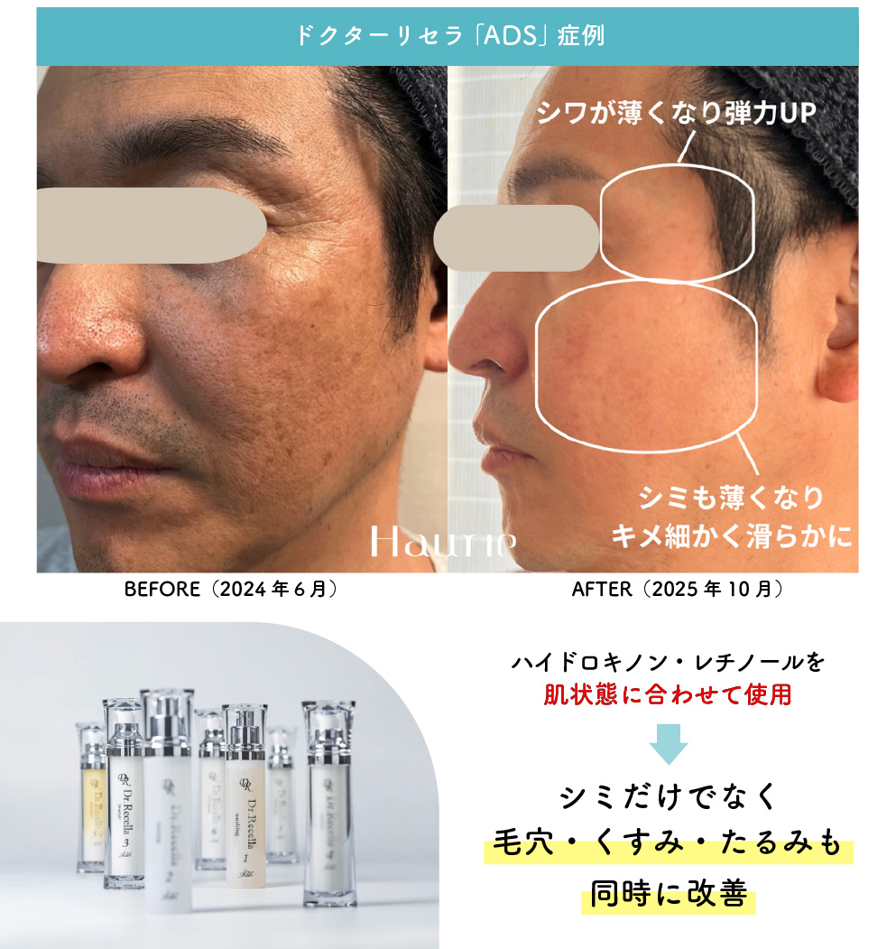 ドクターリセラADSのビフォーアフター