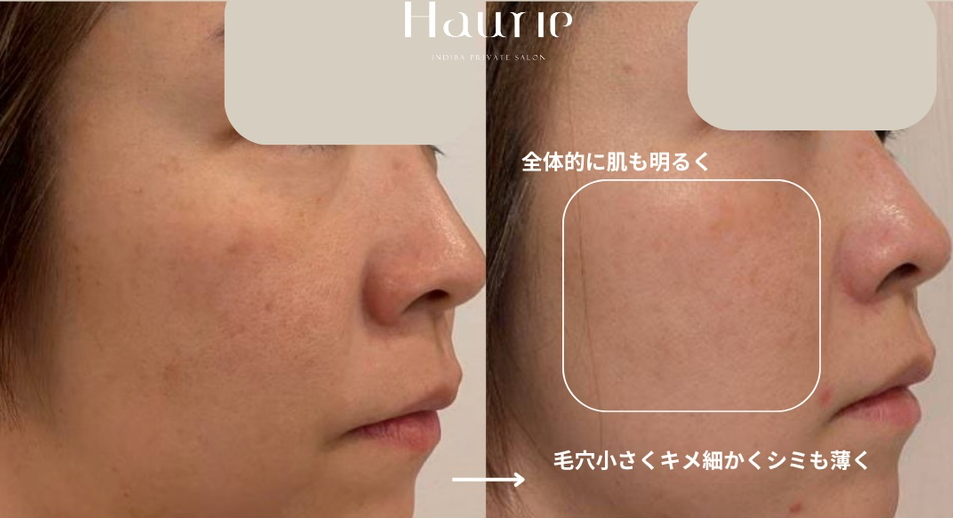インディバサロンハウリーシミ改善のビフォーアフター2